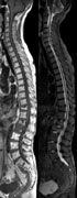 全脊椎MRI