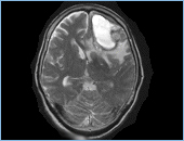 MRI頭部画像